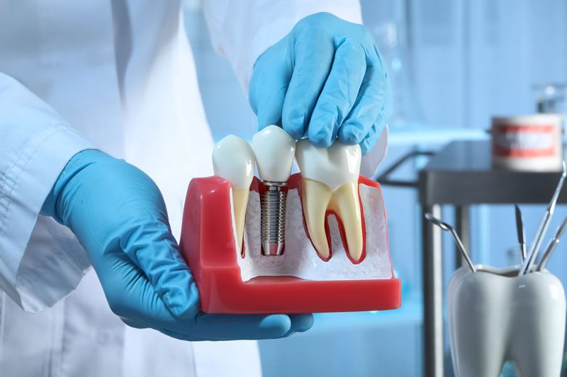 Unraveling the Relationship Between Dental Implants and Bone Health