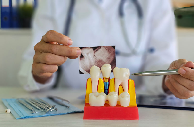 Dental Implant Replacement Essentials: How to Restore Your Smile & Confidence
