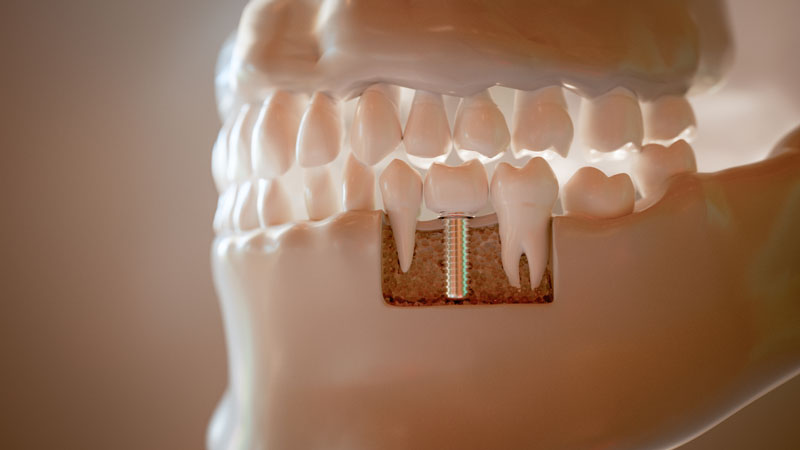 illistraited 3d image model of a jaw with a dental implant placed as demonstration